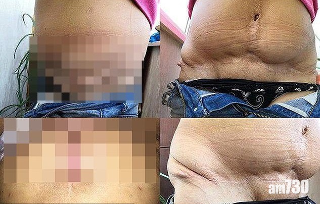 【地獄整容】女醫被指用手機燈照住做手術  又搞到病人冇鼻 