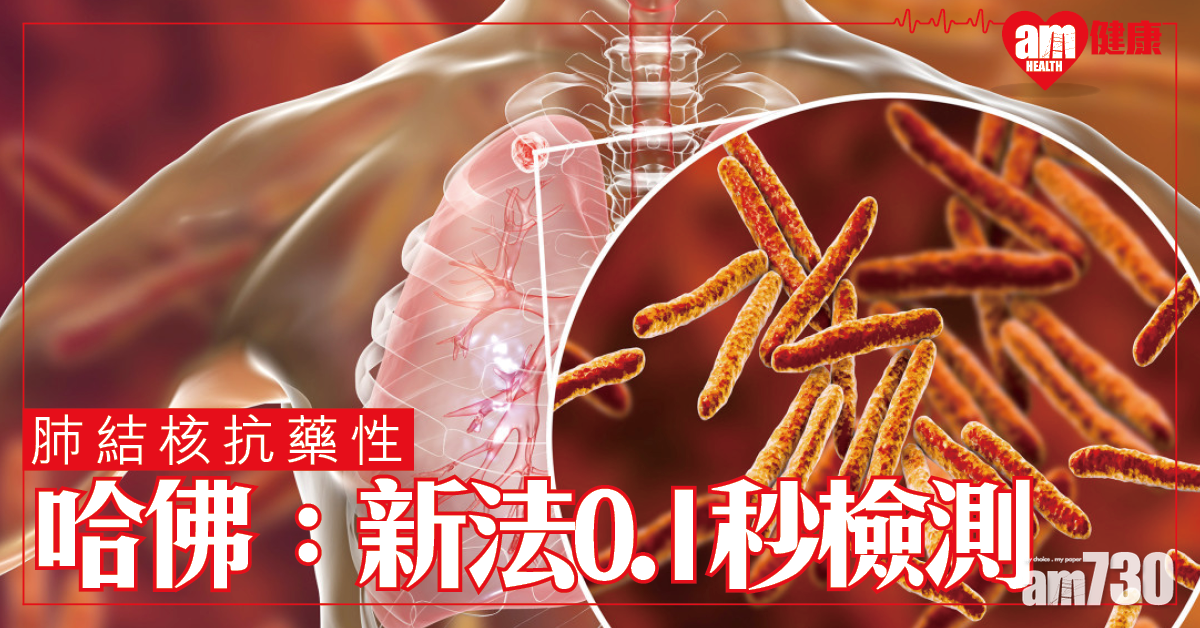 【肺結核抗藥性】哈佛：新方法能0.1秒準確檢測