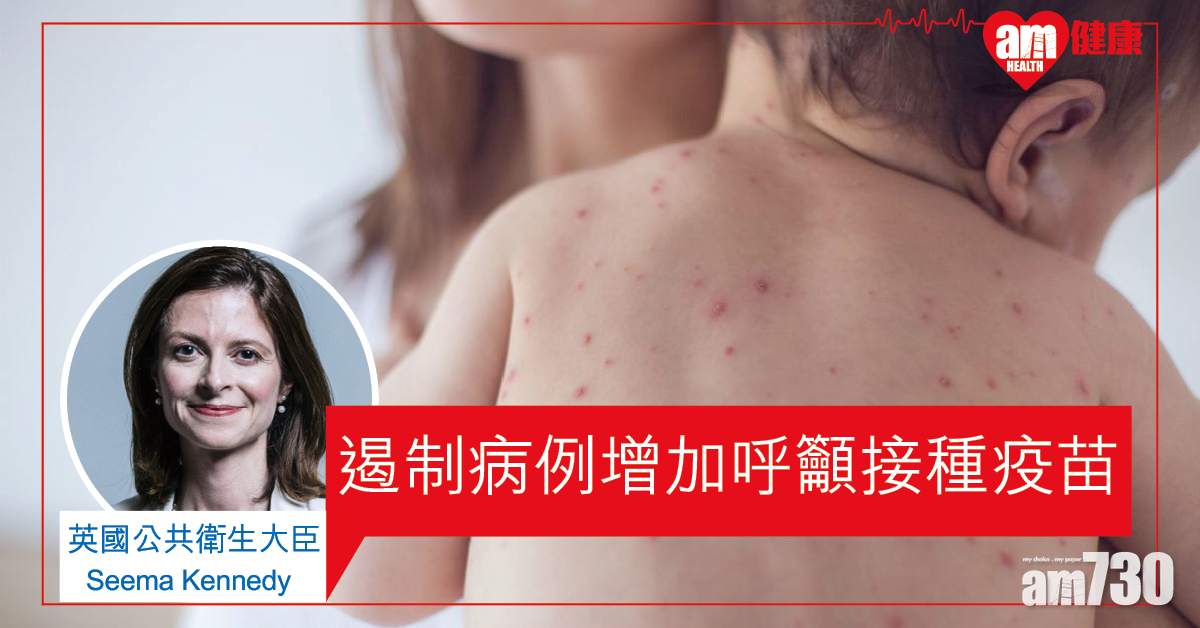 急增逾千麻疹個案 英政府促請父母帶子女打疫苗