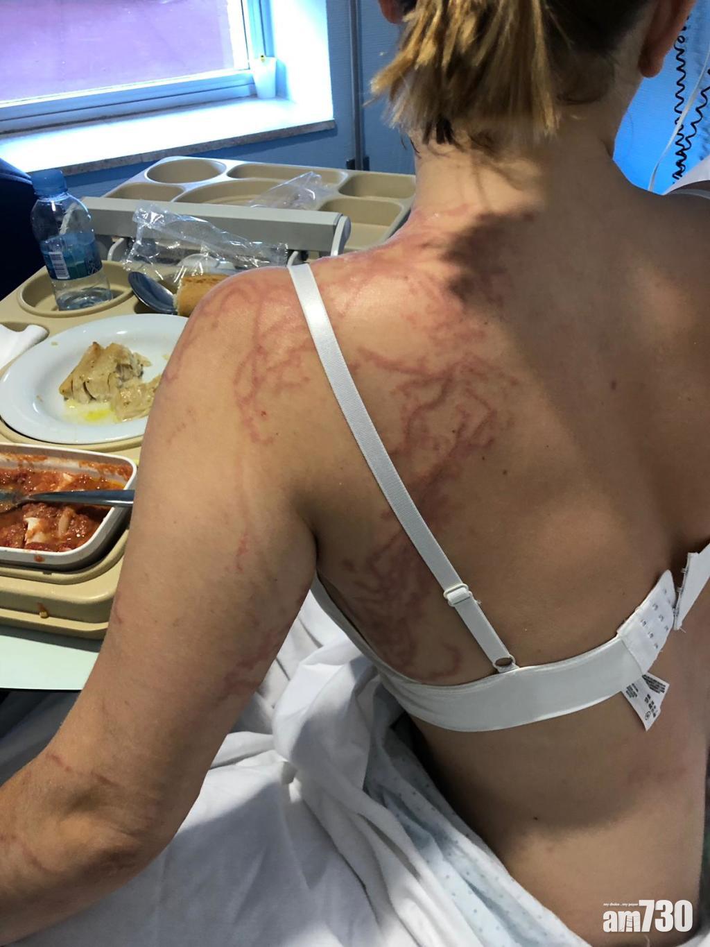 【痛到郁唔到】海灘遭僧帽水母螫傷  22歲女留恐怖傷痕