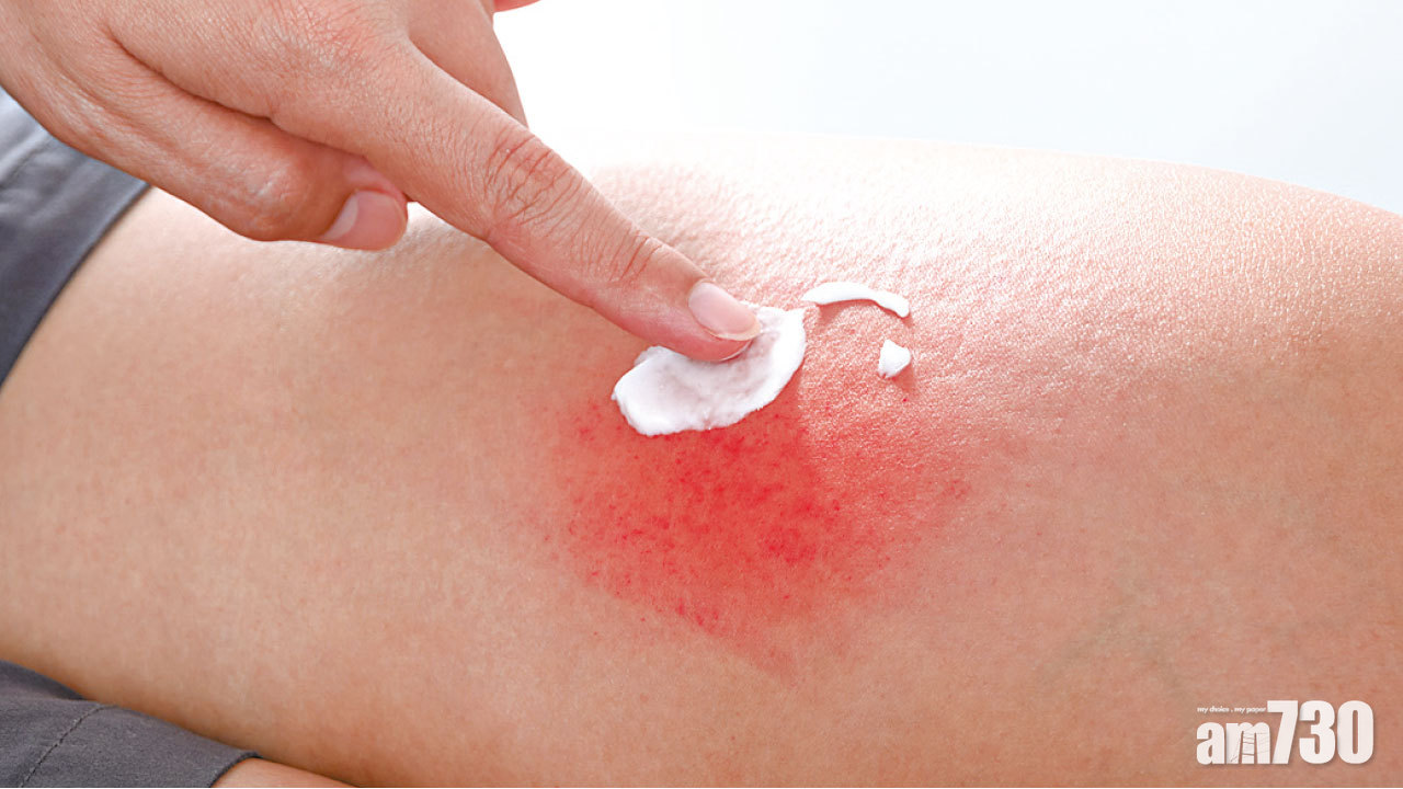 濕疹日常護理