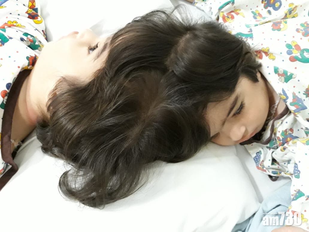 頭部相連雙胞胎女嬰成功分割　手術逾50小時動員100名醫護