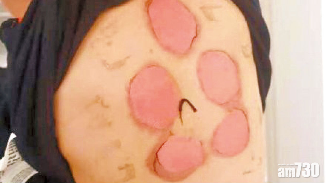 背部紅腫甩皮生水泡  江西92童貼三伏貼灼傷