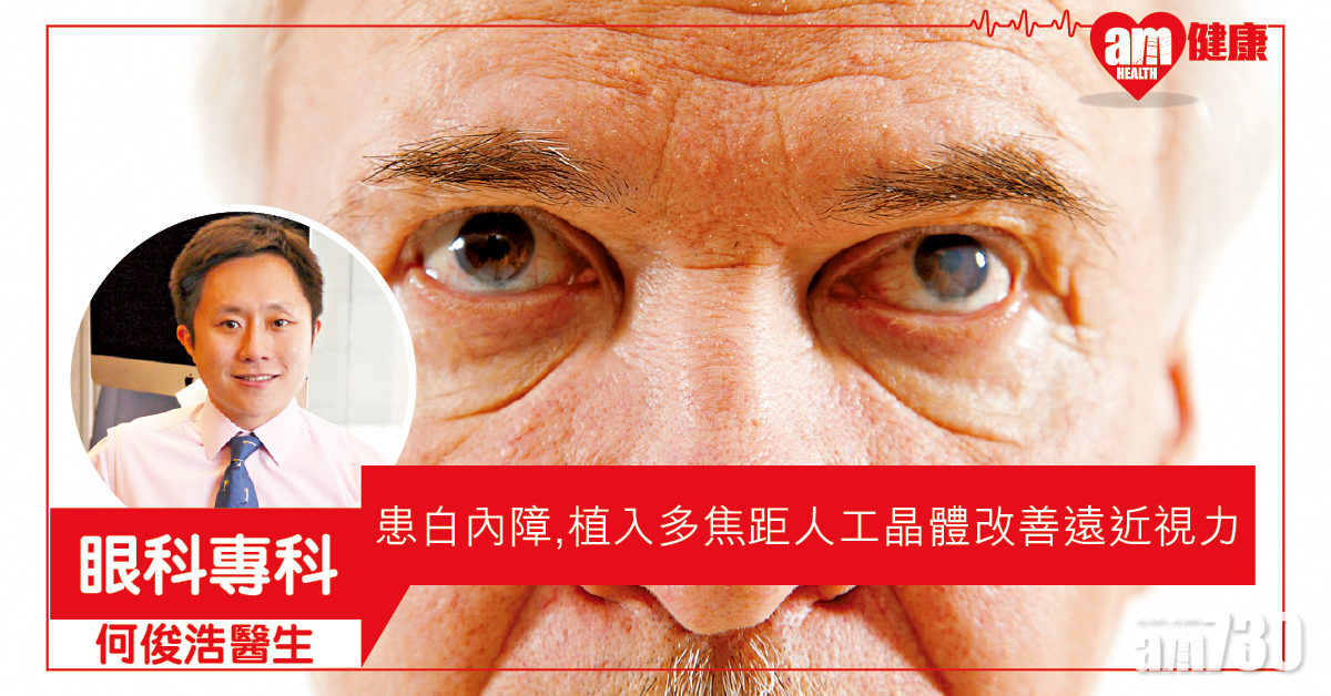 白內障年輕化 換多焦距晶體 遠近睇晒