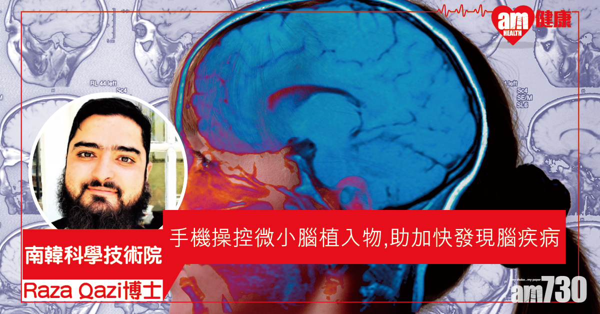 【用手機掌控】韓美合研微小腦植入物 有助加快發現腦疾病