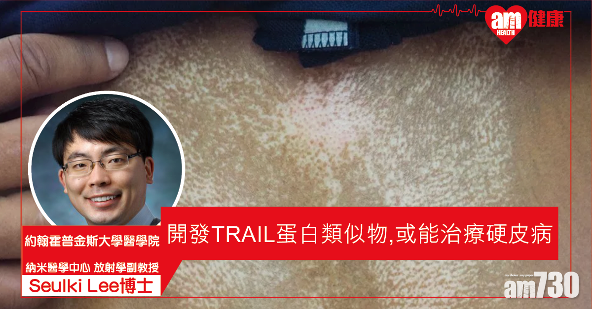 【翻叮研究】發現TRAIL蛋白或能治療硬皮病