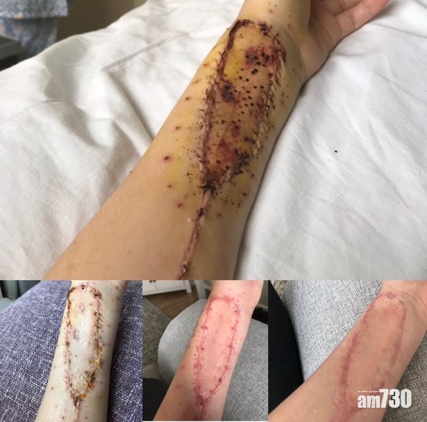 【創新手術】英女患舌癌　移植手臂皮膚修補舌頭