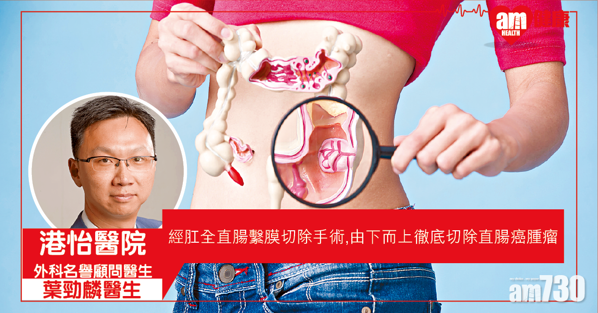 由下而上 徹底切除直腸癌腫瘤