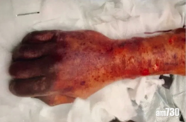 【養寵物注意】六旬漢沒傷口 被愛犬舔後染菌患敗血症亡