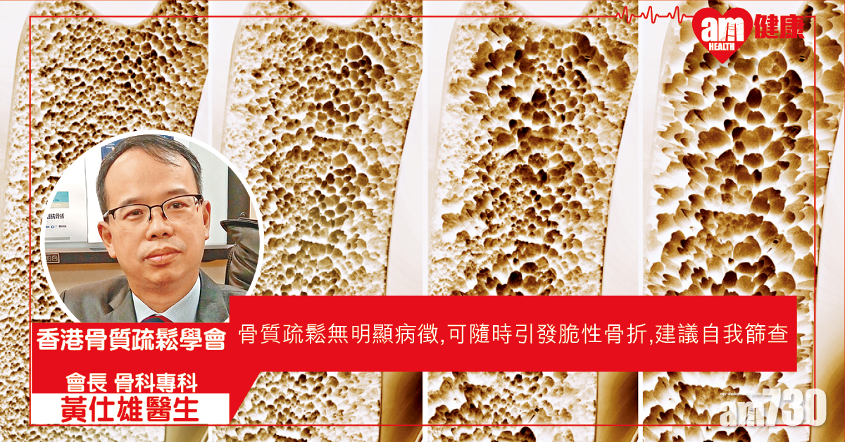 骨質疏鬆篩查 避免脆性骨折