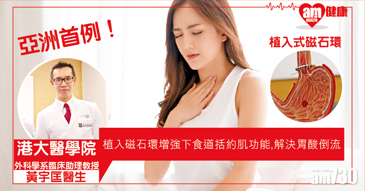 植入磁石環 解決胃酸倒流