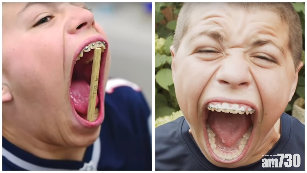 【有片】美國14歲少年張開口達10厘米　獲健力氏世界紀錄