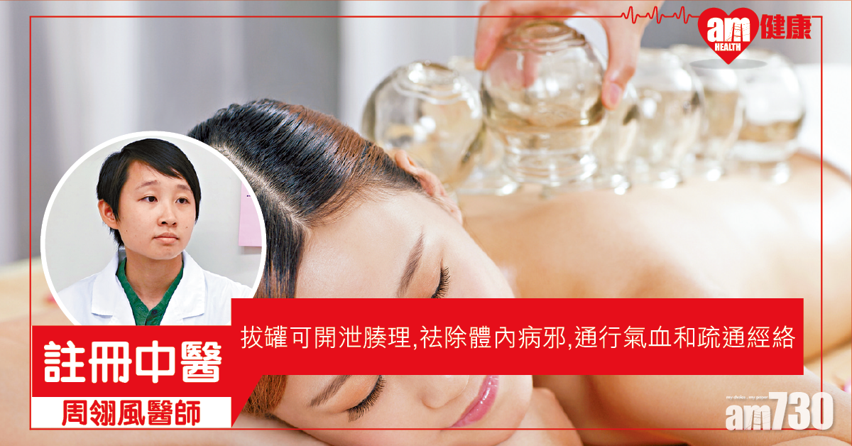 拔火罐 祛病邪鬆肌肉