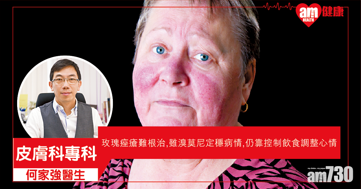 注意飲食、情緒 助控玫瑰痤瘡