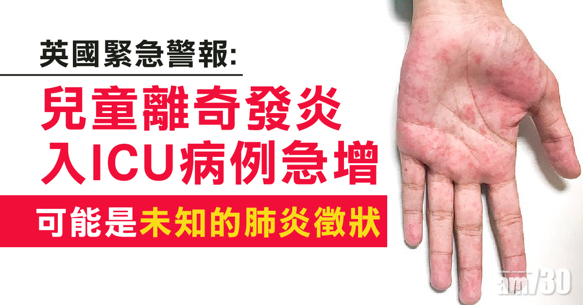 【新冠肺炎】英緊急警報︰兒童離奇發炎入ICU病例急增