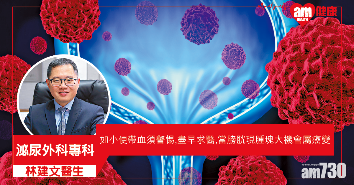 膀胱有腫塊 九成屬癌變