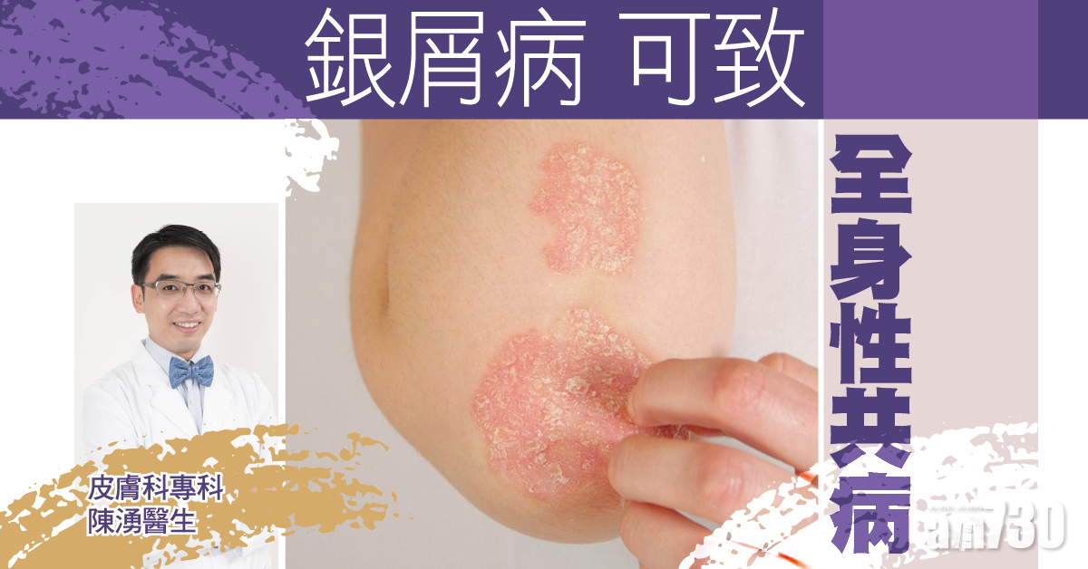 健康快訊：銀屑病可致全身性共病 全面治療防看不見的影響