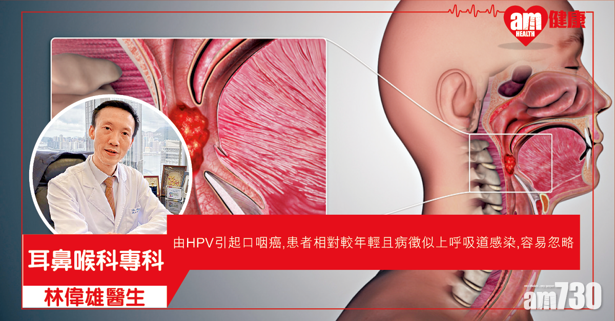 HPV感染可致口咽癌