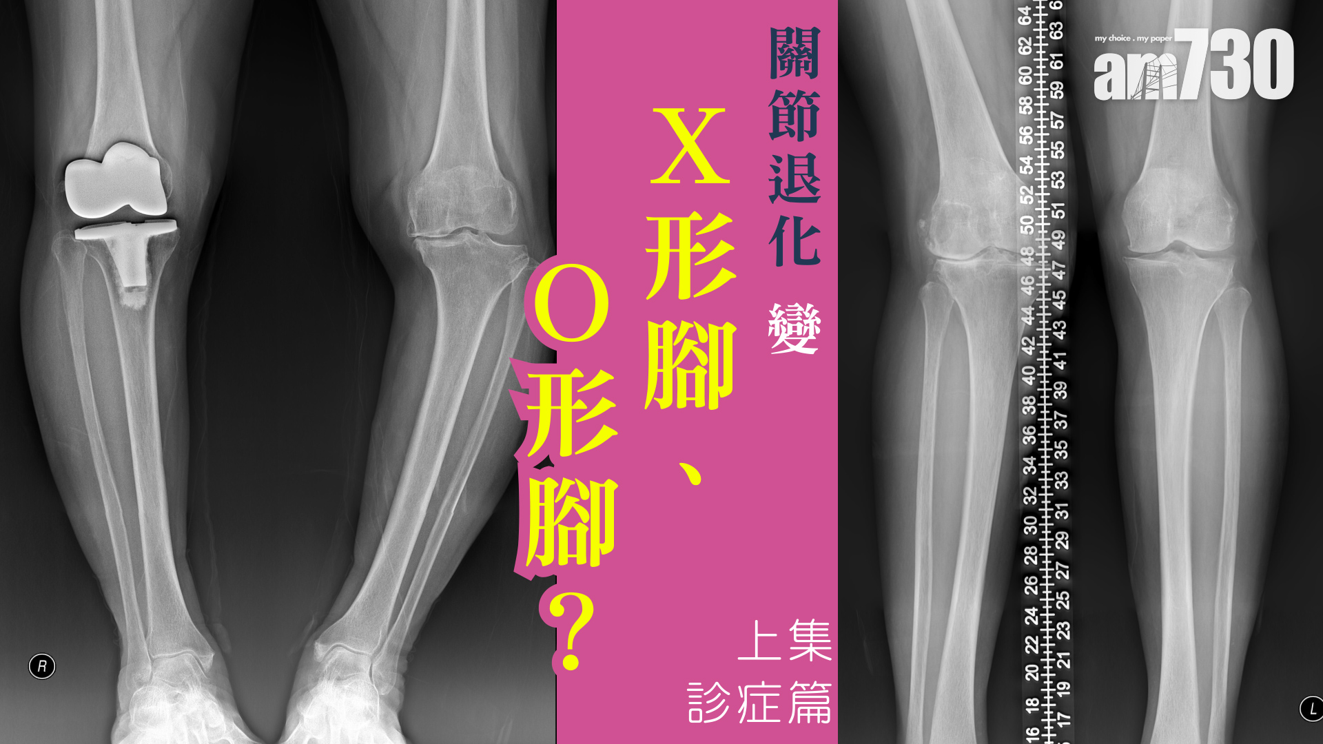 關節退化 變X形腳、O形腳？診症篇