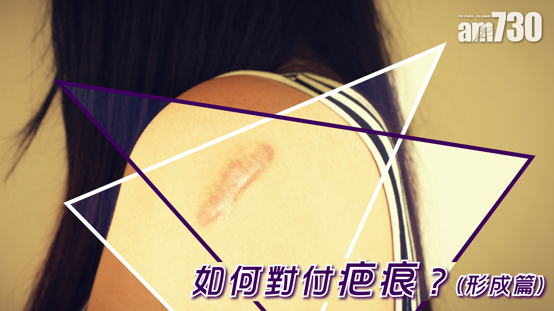 如何對付疤痕？(形成篇)