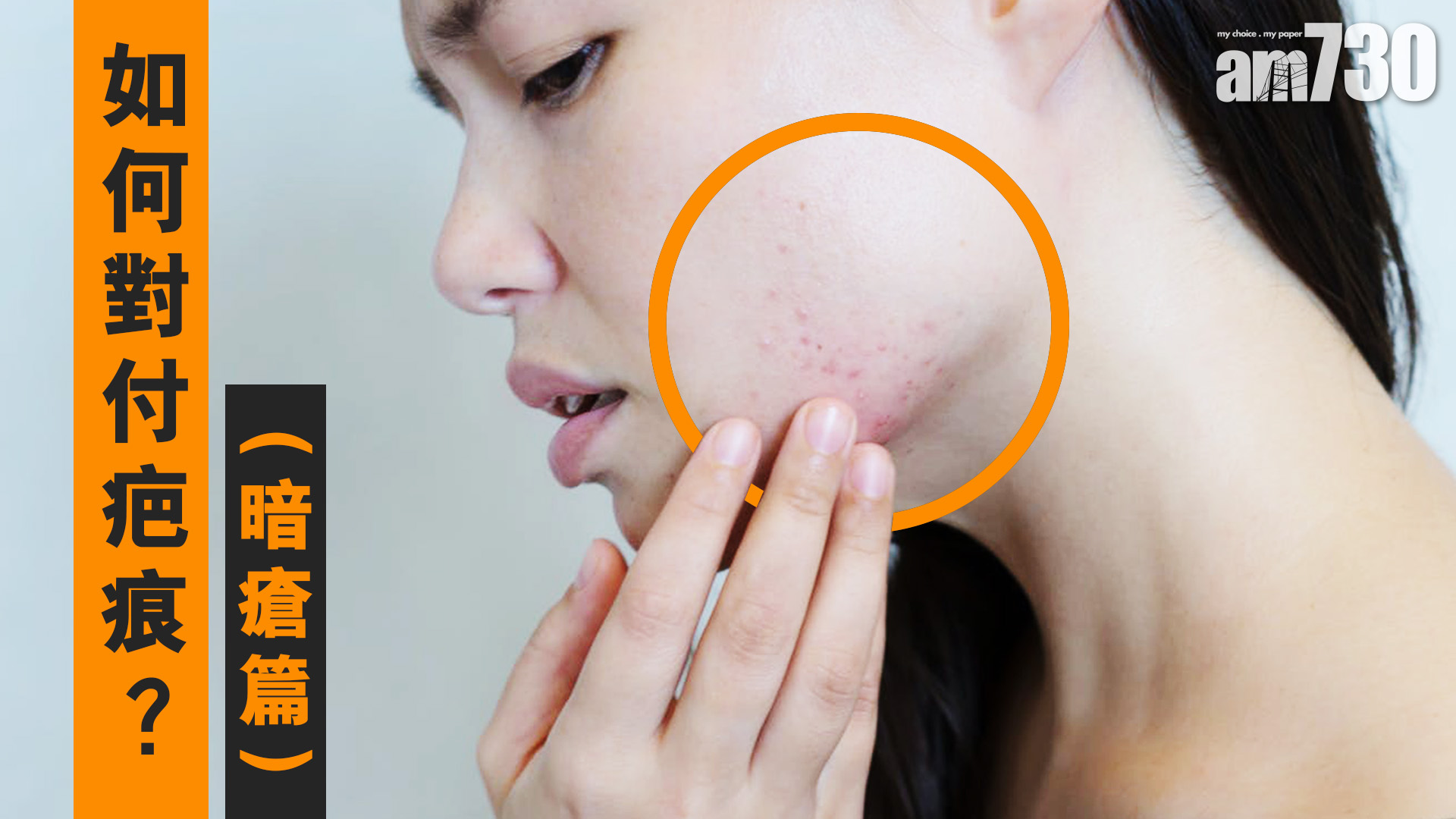 如何對付疤痕？(暗瘡篇)