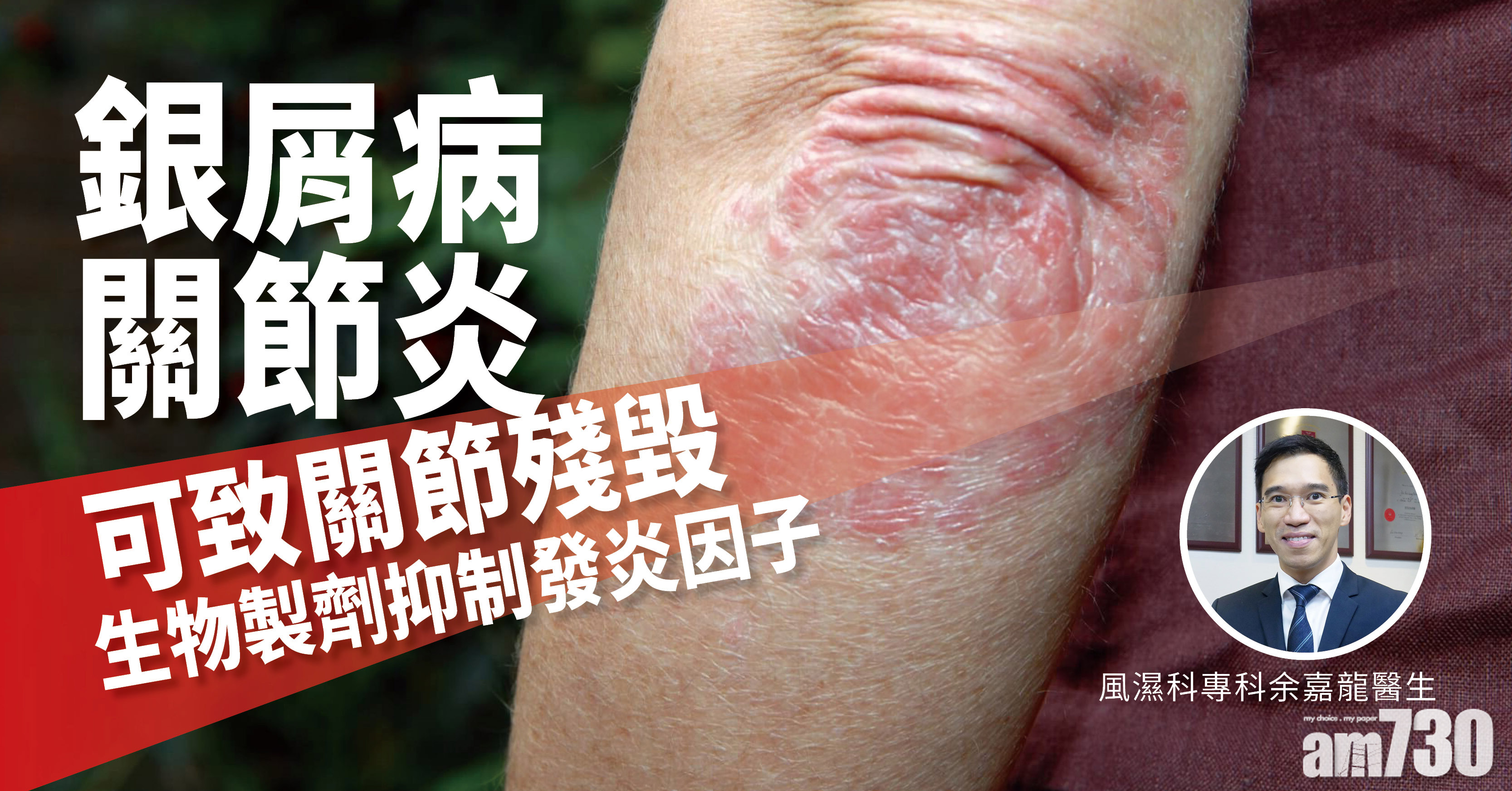 [健康快訊] 銀屑病關節炎可致關節殘毀 生物製劑針對抑制發炎因子