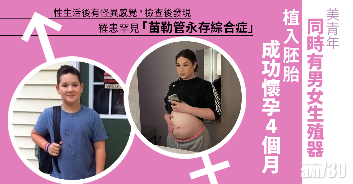 美青年同時有男女生殖器 植入胚胎成功懷孕4個月