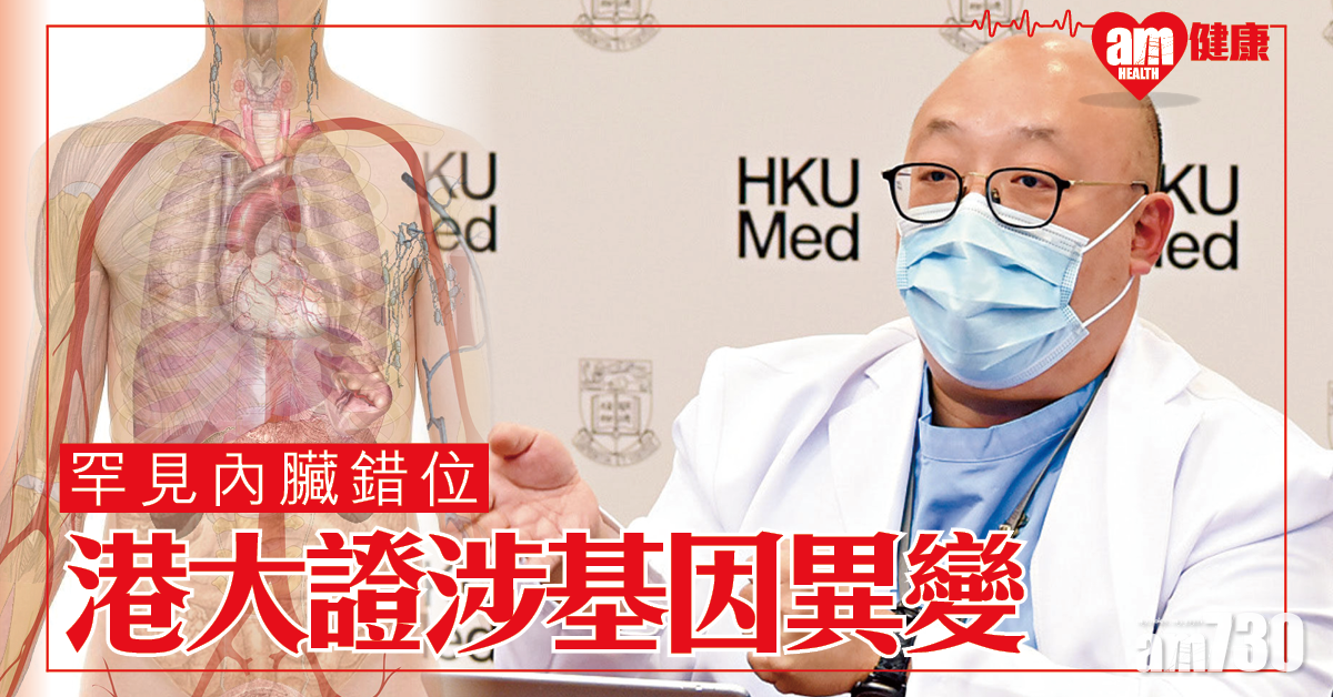 治療曙光 罕見病「內臟錯位」 港大證涉基因異變