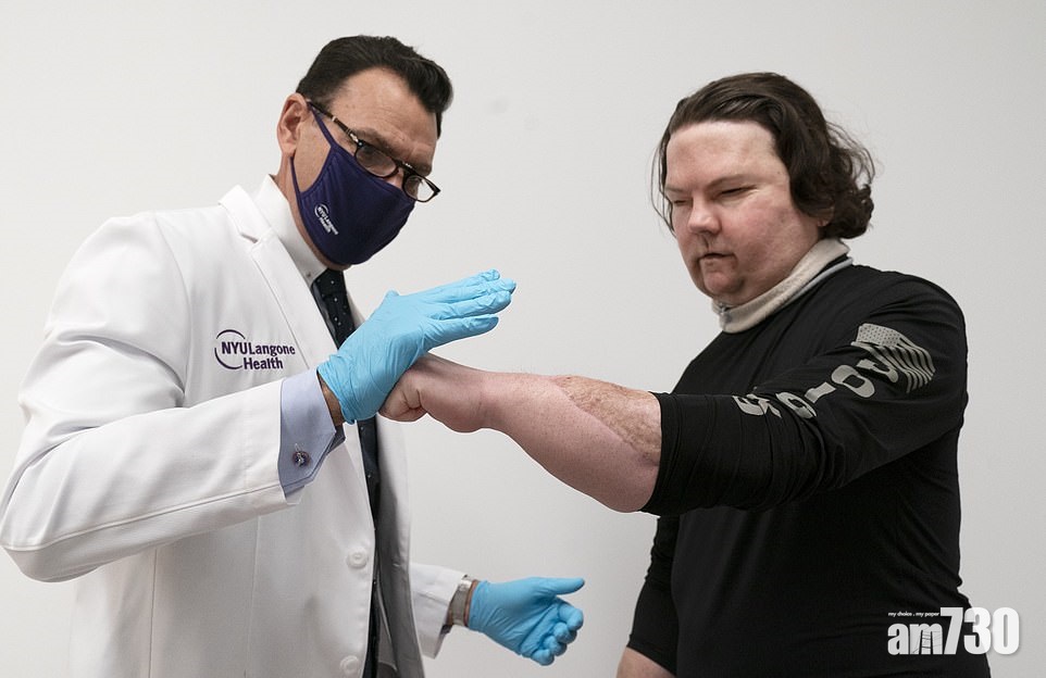 全球首宗｜男子車禍八成燒傷換臉兼移植雙手  來自同一捐贈者