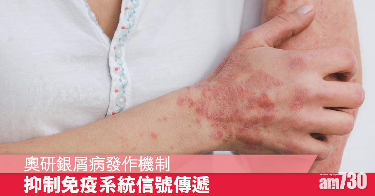銀屑病丨奧地利研究發現抑制發病潛在方法