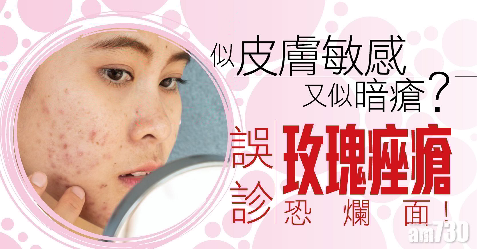 似皮膚敏感又似暗瘡？誤診玫瑰痤瘡恐爛面！