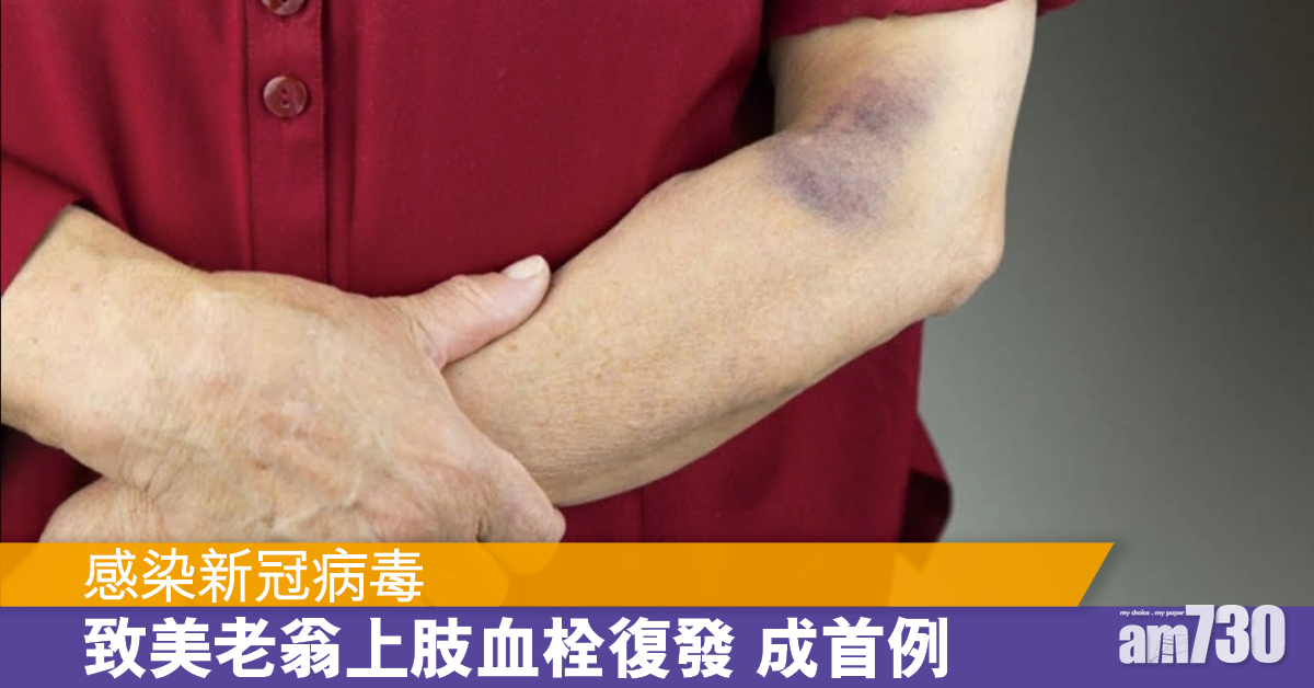 新冠肺炎丨美老翁確診後令上肢血栓復發