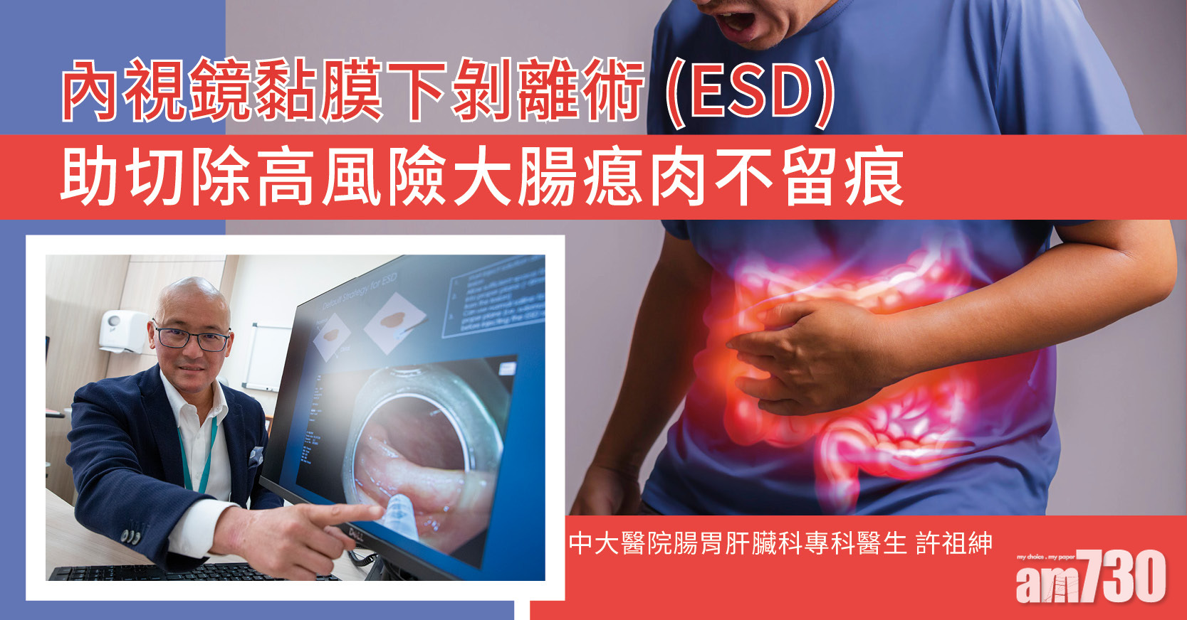 內視鏡黏膜下剝離術(ESD) 助切除高風險大腸瘜肉不留痕