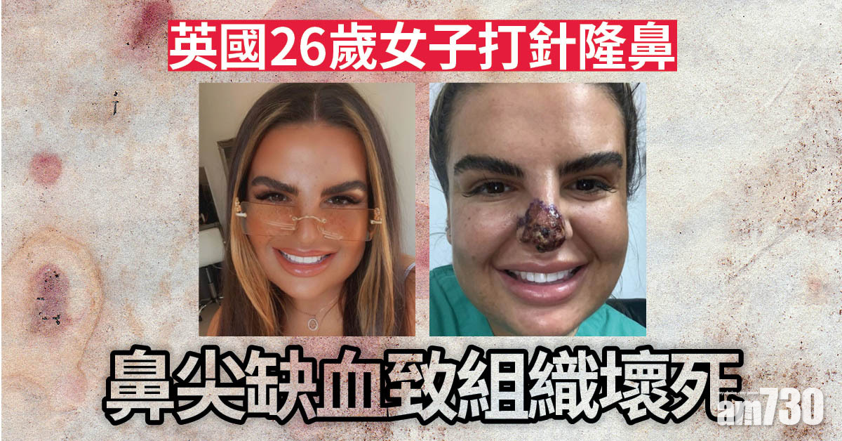 貪靚注意｜英26歲女打針隆鼻  鼻尖缺血致組織壞死變黑