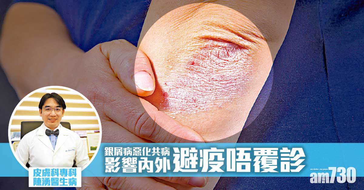 銀屑病疫情下易惡化 應依時評估