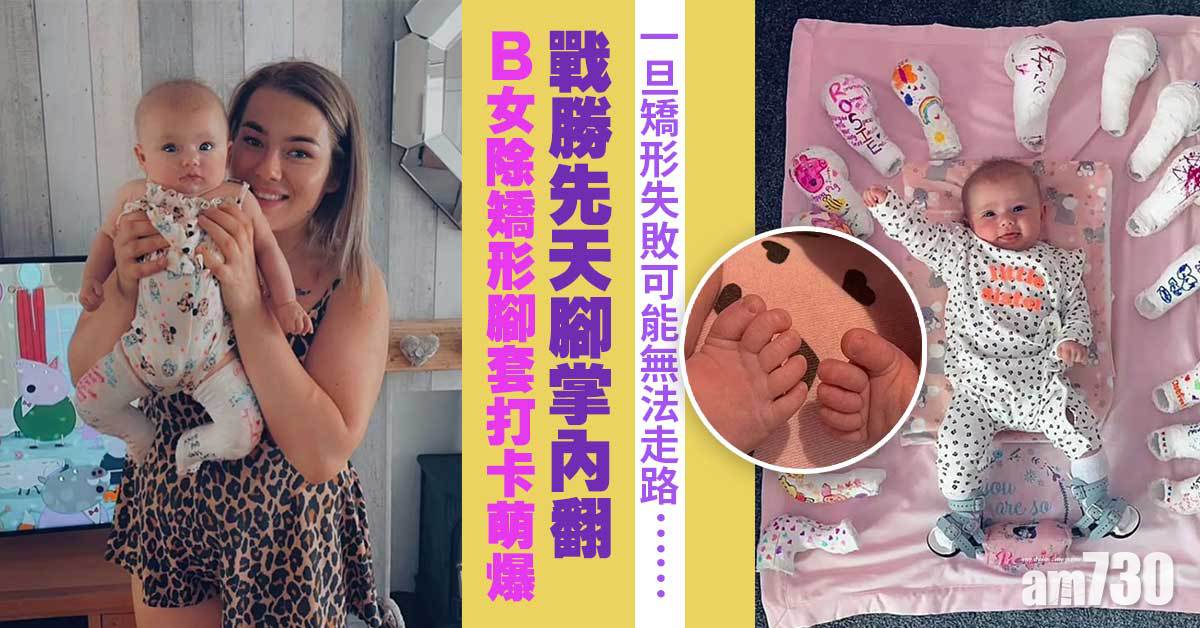 小兒科｜戰勝先天腳掌內翻  3個月大B女除矯形腳套打卡萌爆