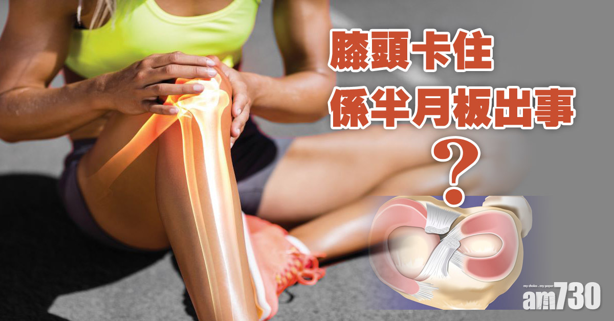 半月板｜3個徵兆代表可能出現撕裂