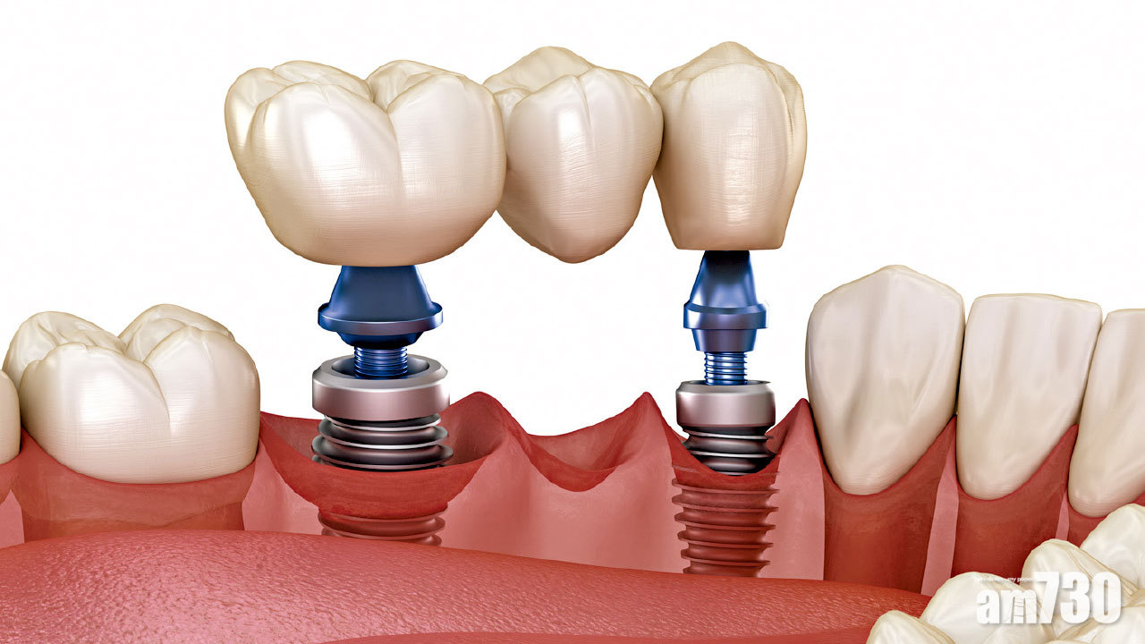 3D實時導航 精準植牙