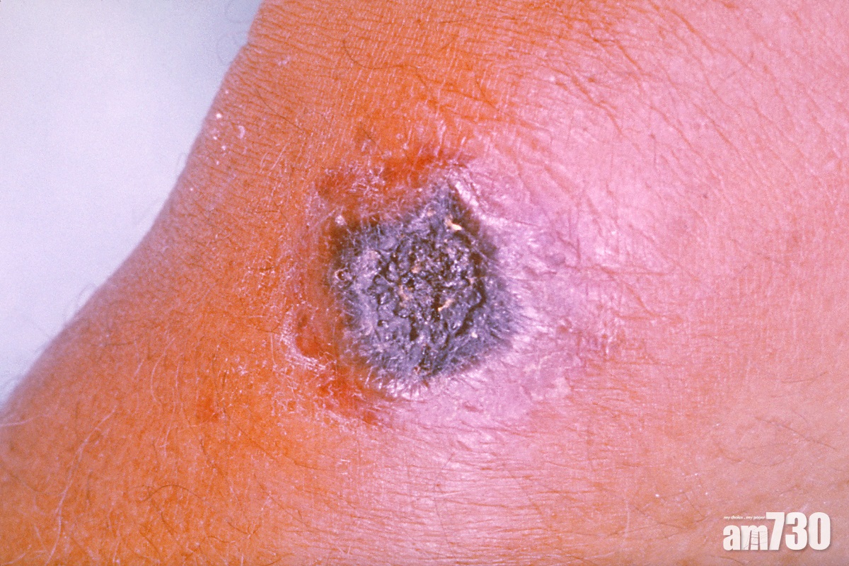 炭疽｜山東爆疫？認清3種感染途徑