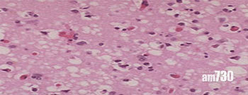 瘋牛症｜瘋牛症可傳人 腦部變海綿無藥可醫 一文看清典型非典型 克雅二氏症又係乜？