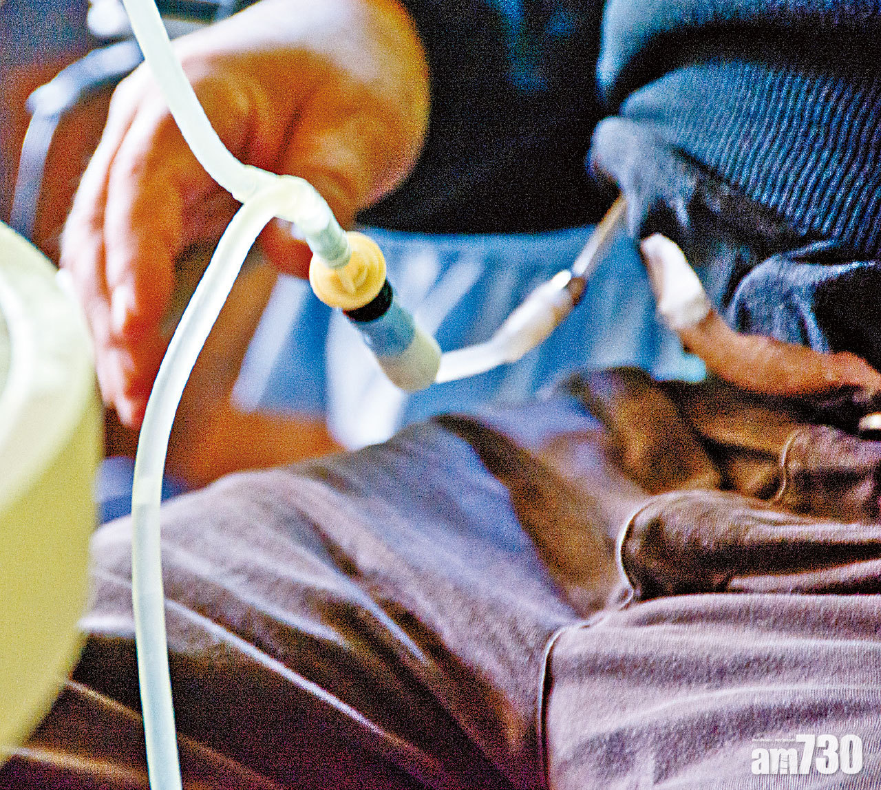 末期腎病 透析治療助續命