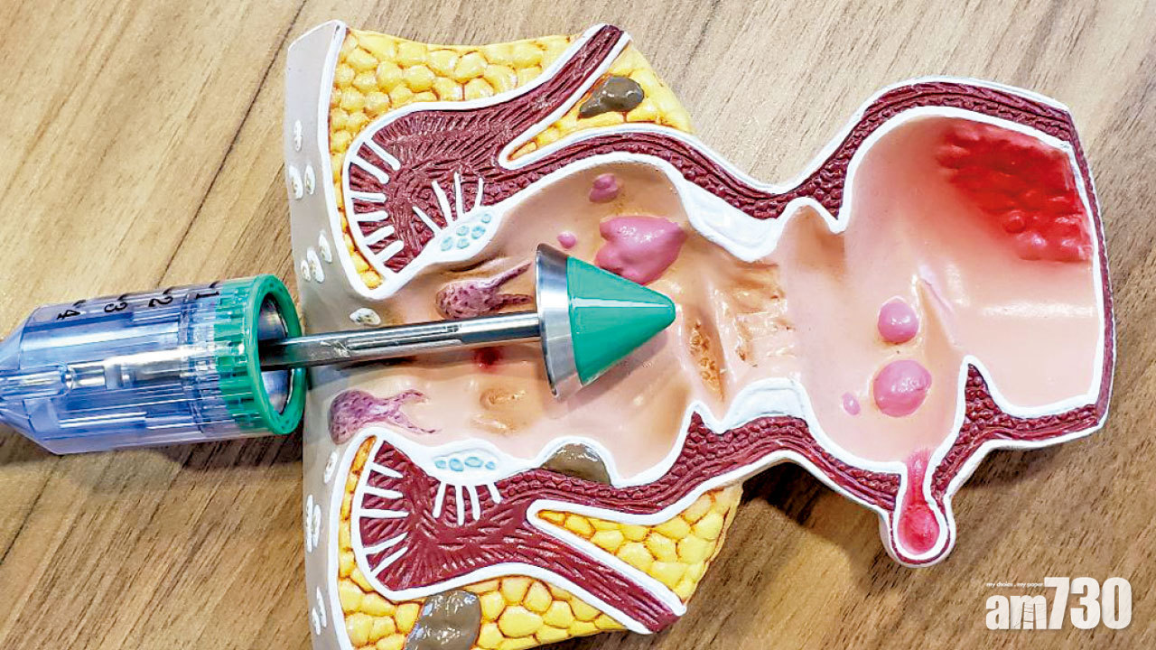 痔瘡療法點樣揀？