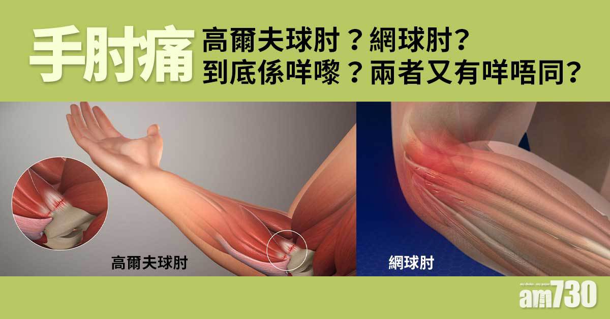 手肘痛｜咩叫高爾夫球肘？同網球肘點分？