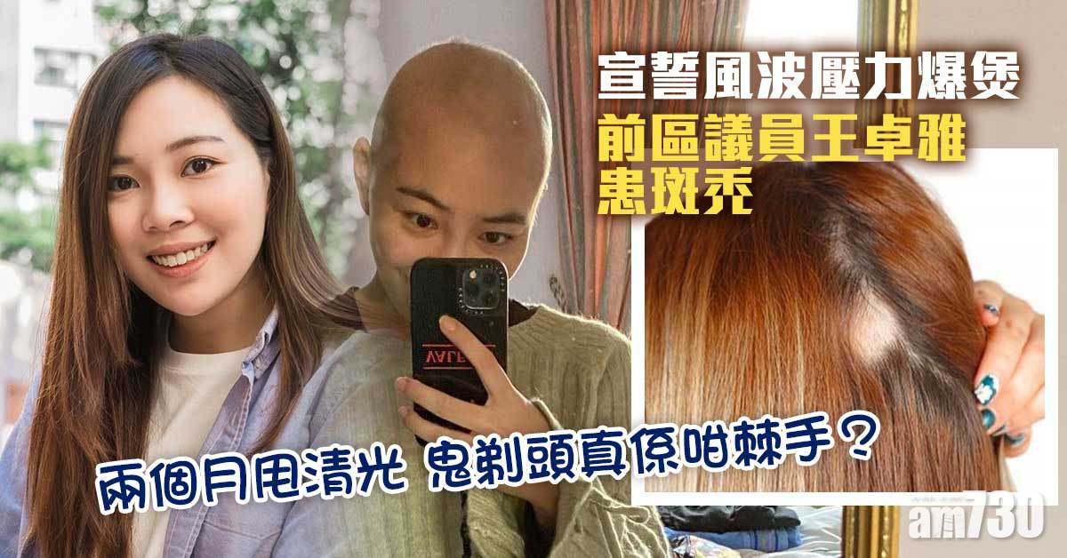 鬼剃頭丨DQ風波令王卓雅受壓患斑禿 秀髮兩月甩清光