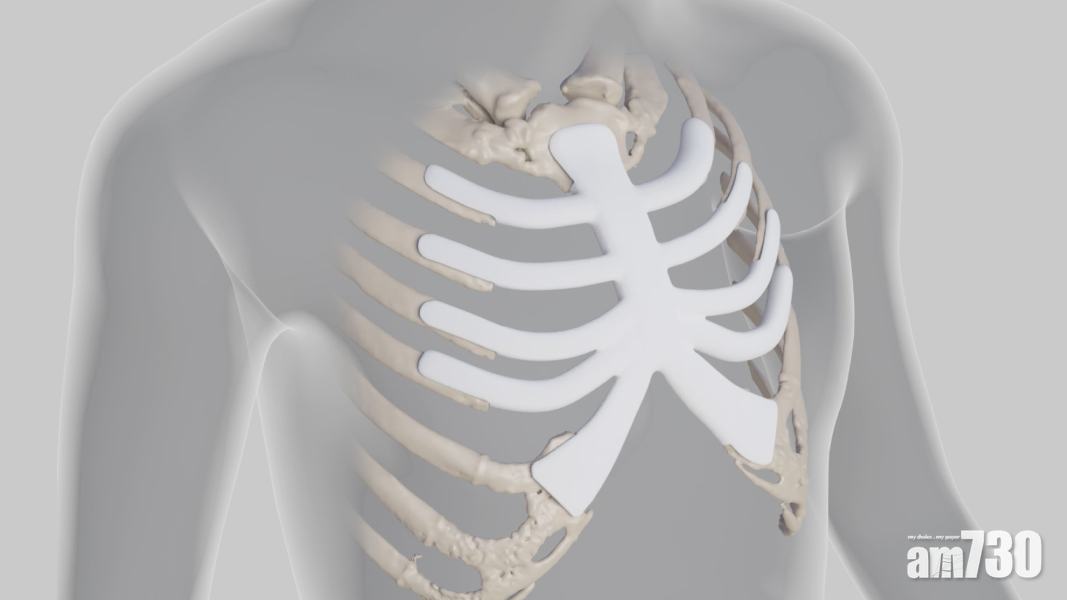 胸腔重建丨澳生物醫療科技 3D打印植入物能與人體「共存」