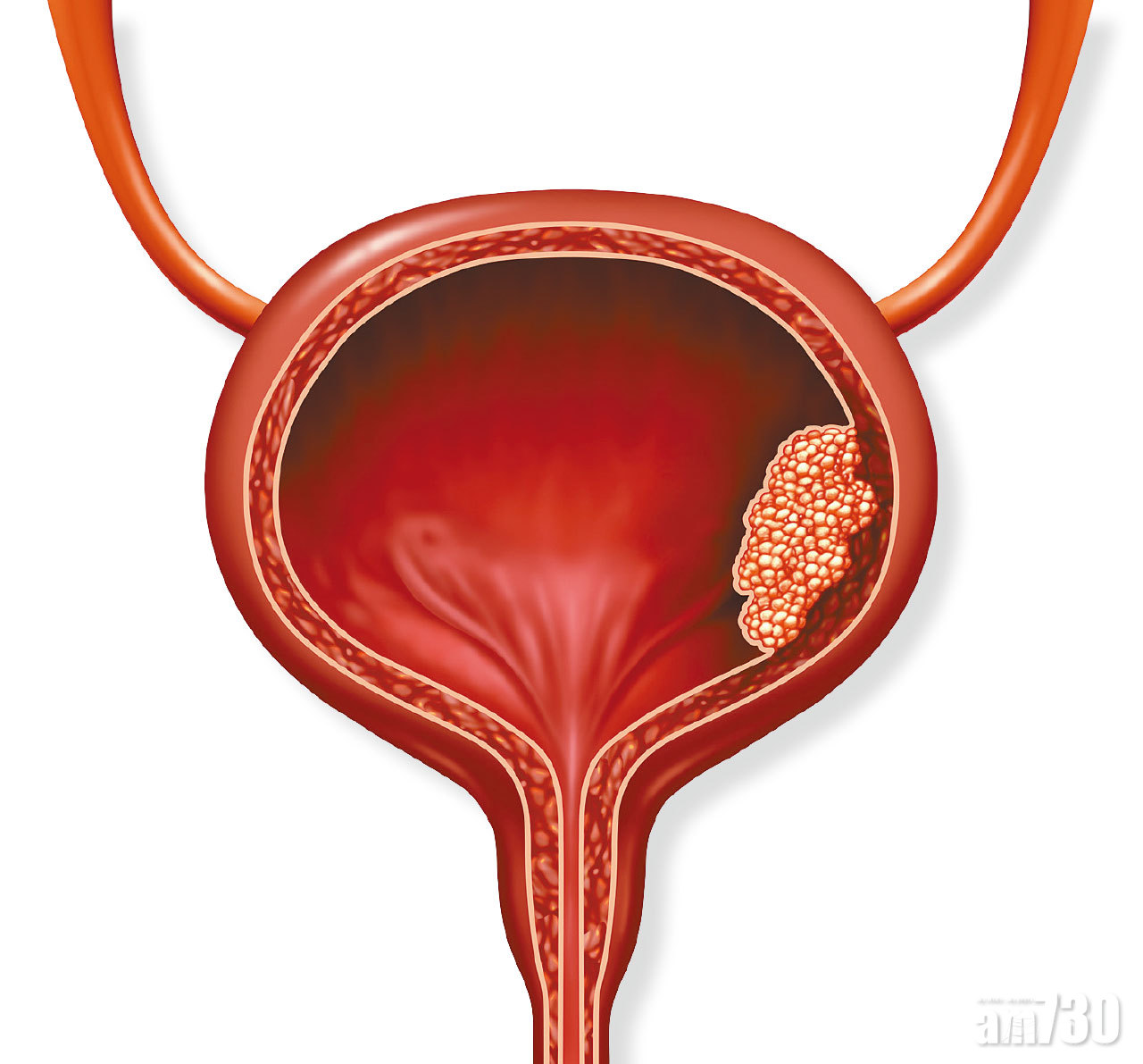 膀胱癌 體內尿路重建減創傷