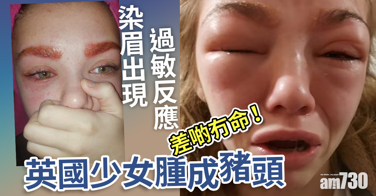 少女染眉敏感腫成豬頭 險失明送命
