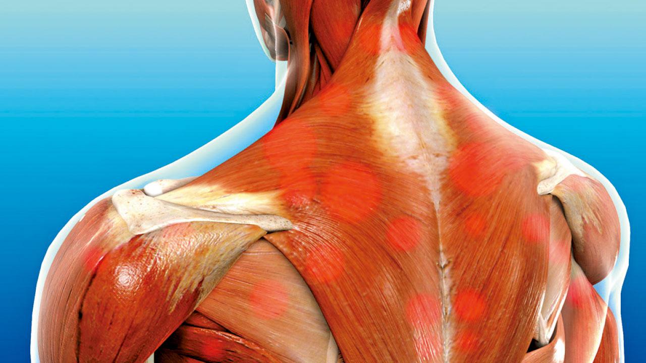 肌筋膜疼痛綜合症