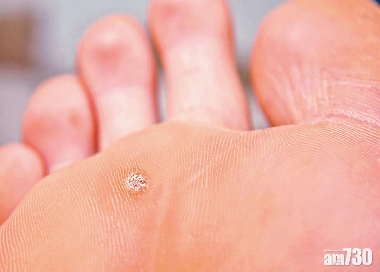 消委會指,有美容中心誇大疣的影響,引誘消費者購買高額美容療程。(資料圖片)