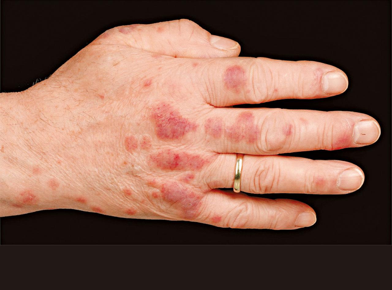 癌症可致急性情況 迅速奪命